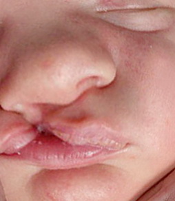 cleft lip cleft palate1